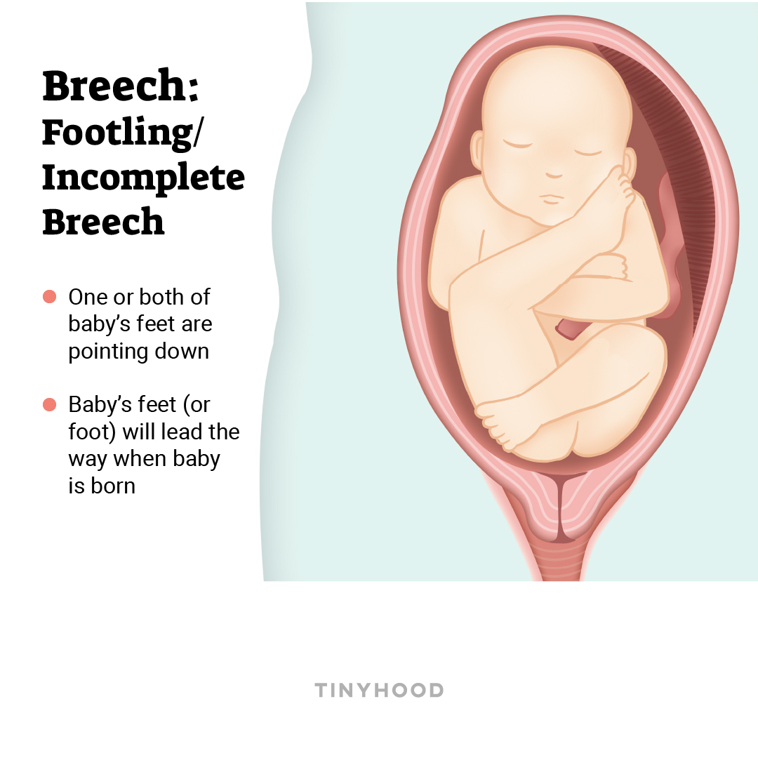 How to know if baby is sunny side deals up